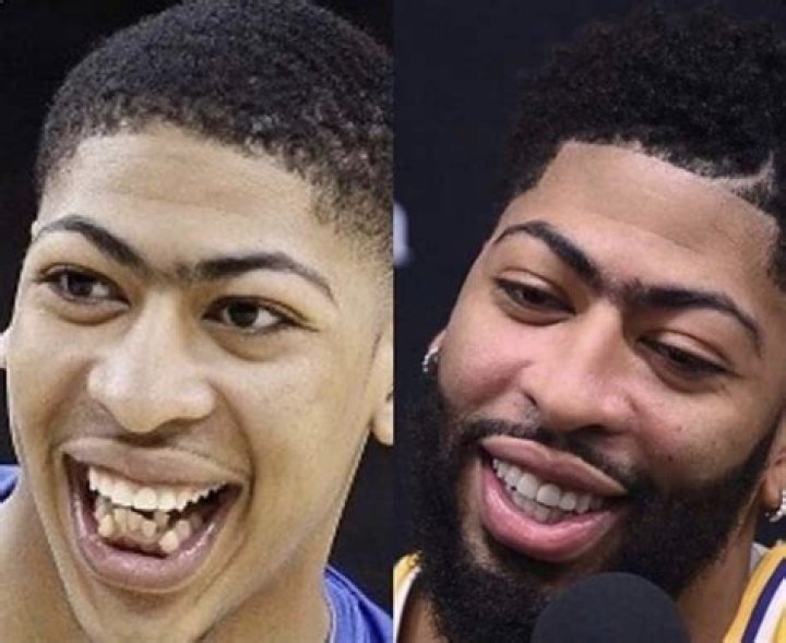 Glimpse Of Anthony Davis Before And After Teeth