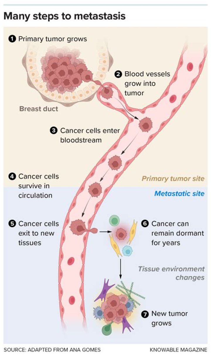 
IIT team identifies proteins that can help predict metastatic breast cancer 