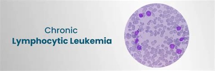 
Seven Network’s Bruce McAvaney Illness: An Update On His Chronic Lymphocytic Leukemia And Health 