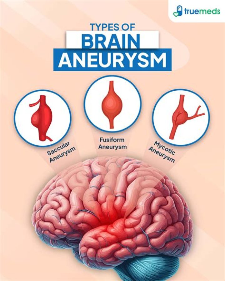 
What is brain aneurysm? Causes and symptoms explored as Tom Sizemore hospitalized in critical condition 