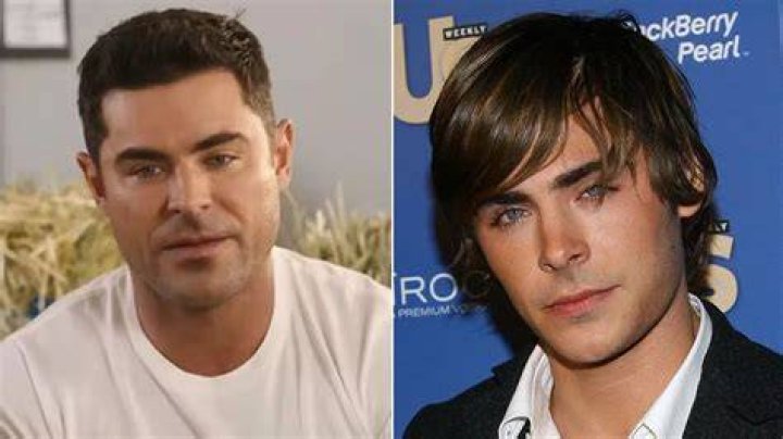 Zac Efron Face Accident: Did He Have A Plastic Surgery? Before And After
